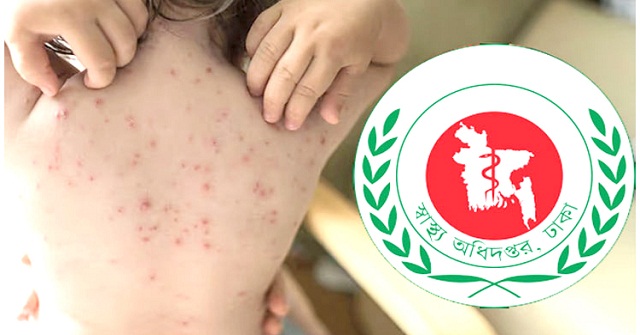 হামে আক্রান্ত হয়ে ছেলের মৃত্যু, মেয়েও ভর্তি হাসপাতালে