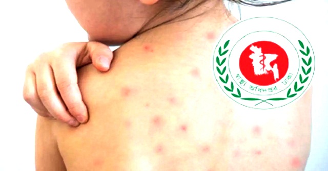 ২৪ ঘণ্টায় হাম সন্দেহে আরও ৪ শিশুর মৃত্যু