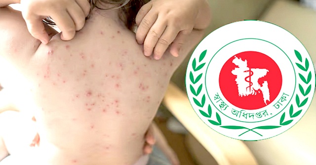 বরিশালে হাম উপসর্গে এক শিশুর মৃত্যু
