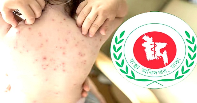 বরিশালে হামের উপসর্গ নিয়ে আরও ২ শিশুর মৃত্যু