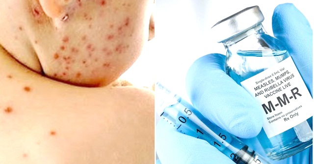 রোববার শুরু হচ্ছে জরুরি হাম-রুবেলা টিকাদান