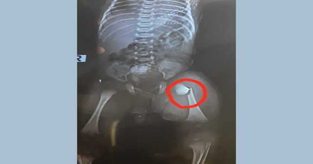 নবজাতকের পা ভাঙ্গার অভিযোগ চিকিৎসকের বিরুদ্ধে 