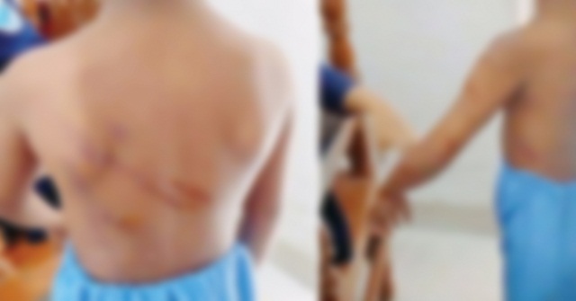 বাকেরগঞ্জে শিক্ষক কর্তৃক মাদরাসা শিক্ষার্থীকে অমানুষিক নির্যাতন