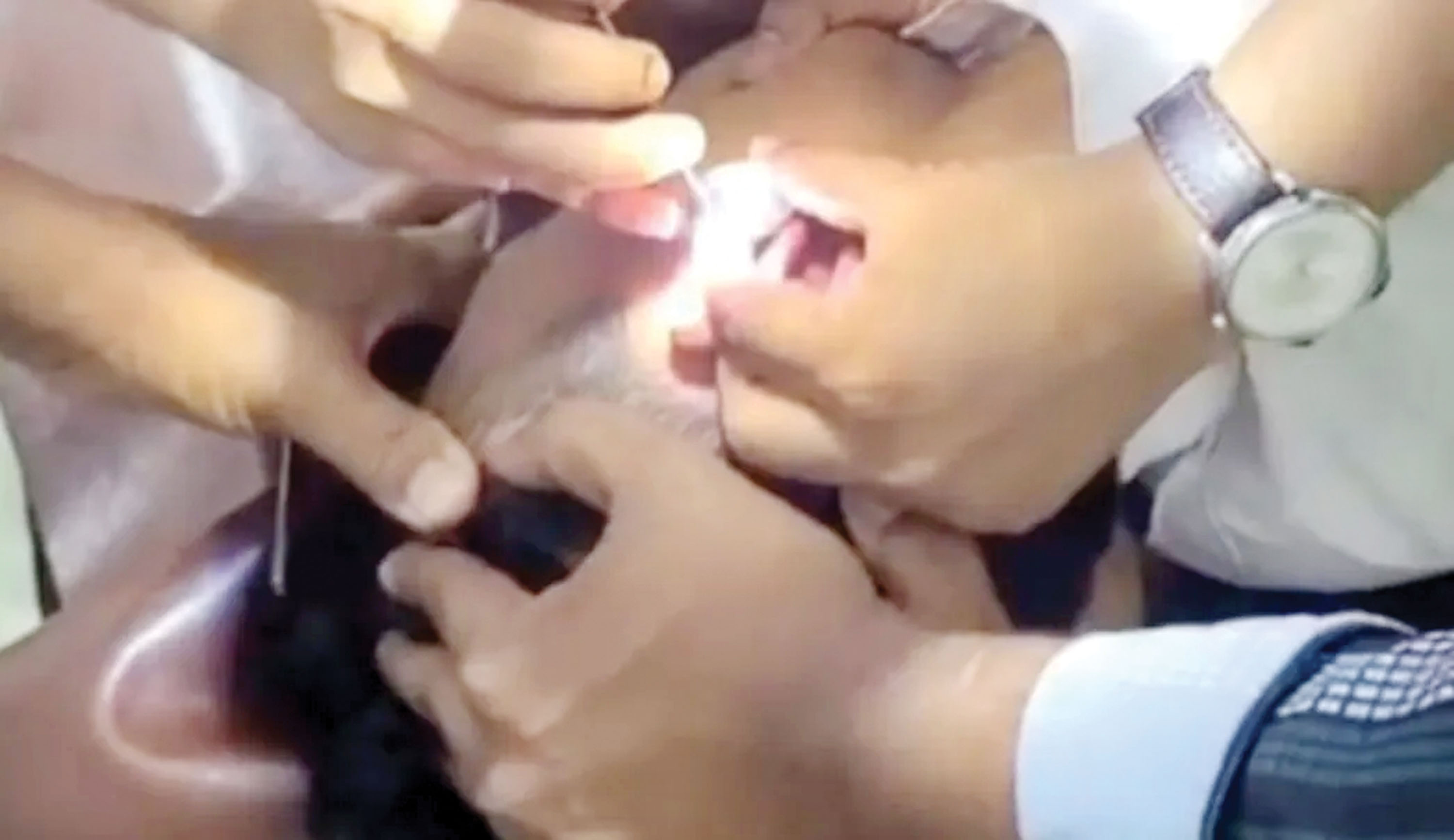 পটুয়াখালীতে তরুণের কানের ভেতর ৯ দিন লুকানো ছিল ইয়াবা, অতঃপর