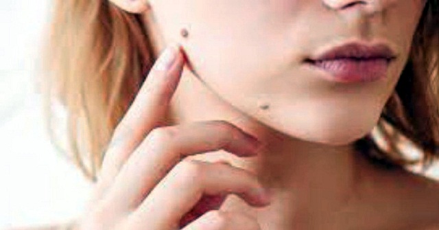 আঁচিল দূর হবে সহজেই 