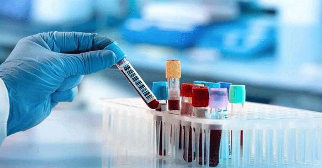 রক্ত পরীক্ষা করেই শনাক্ত করা যাবে আলঝেইমার