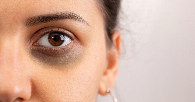 ডার্ক সার্কেল প্রতিরোধের কিছু ঘরোয়া উপায়