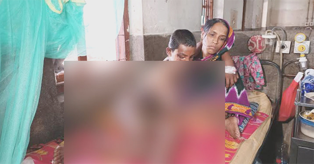 আম-লিচু পাড়ায় প্রতিবন্ধী কিশোরের শরীরে গরম পানি